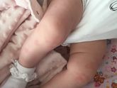 Сыпь. Аллергия ?!