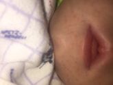 Аллергия?