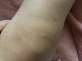 На что похоже? Укус?