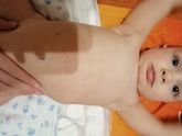 Аллергия на коровий белок., какие симптомы??