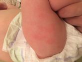 Аллергия???