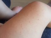 Много букв. Аллергия)