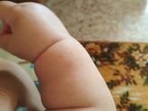 Потничка или аллергия??