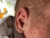 Аллергия или акне новорождённых?