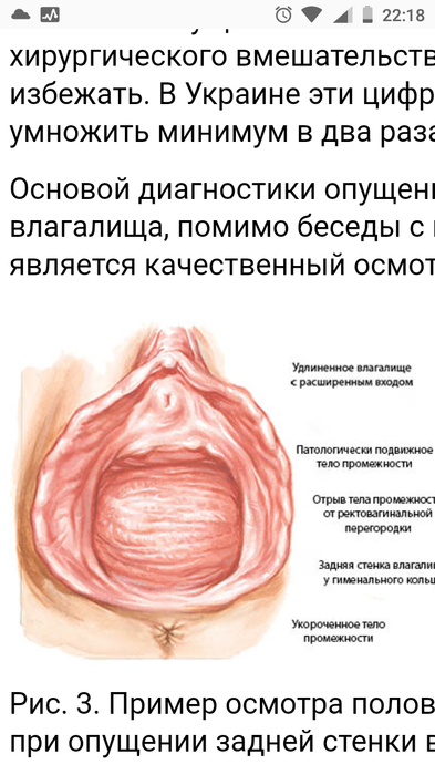 Синехия (сращение) малых половых губ