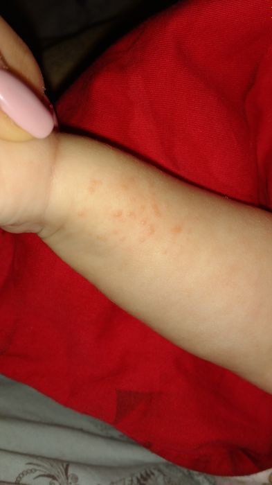 Аллергия на Актиферрин?