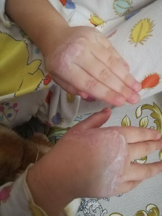 У ребенка 5 лет красные костяшки пальцев на руках и щипят