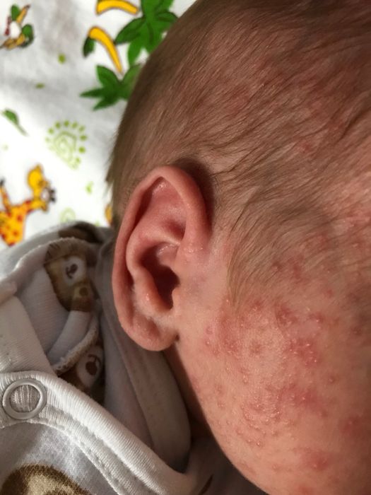 Аллергия или акне новорождённых?