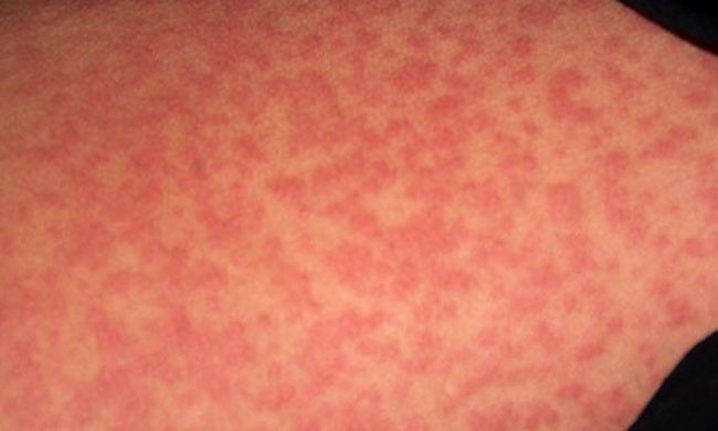 Аллергия у дочки на антибиотики