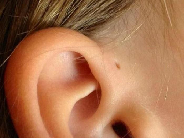 наружный свищ в области уха