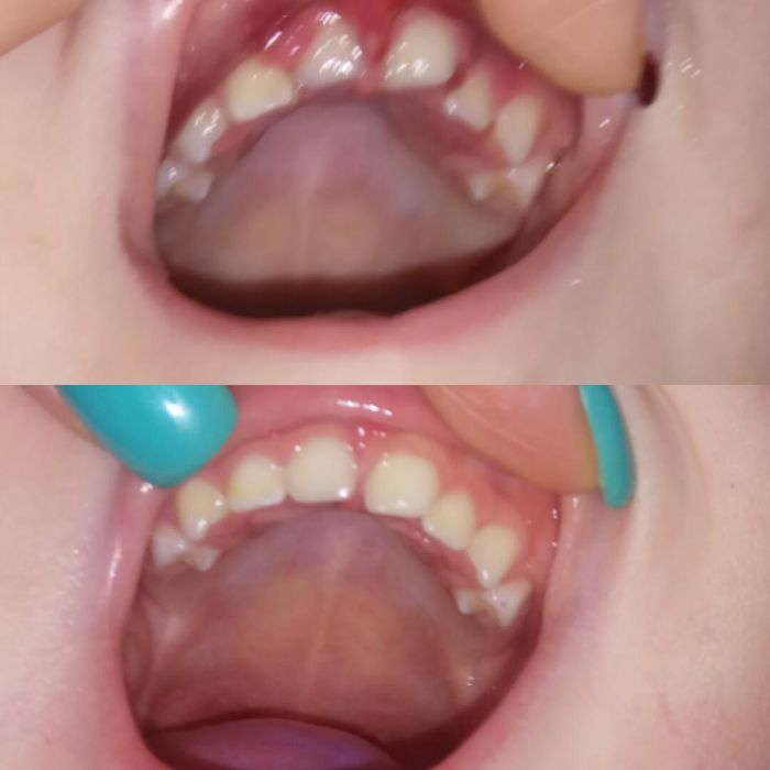 Вколоченный вывих молочных зубов