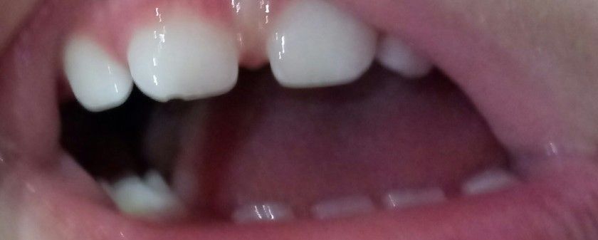 Небольшой скол зуба у дочки(
