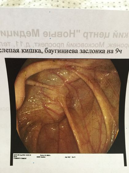 Колоноскопия))))) это загадочное обследование)))