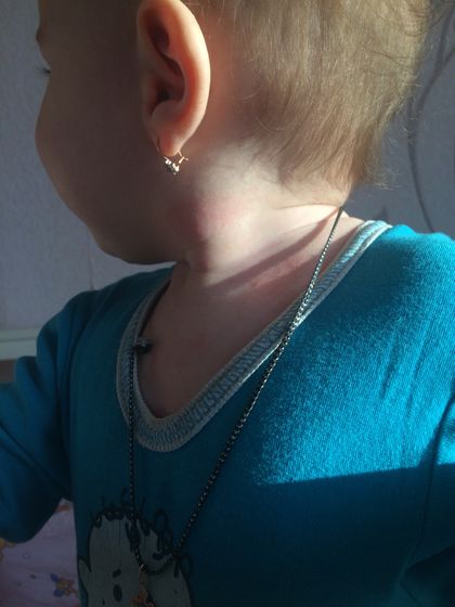 Сыпь на шее