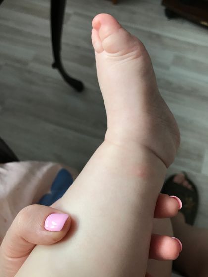 Похоже на аллергическую сыпь?