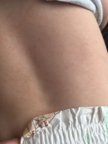 Девочки это аллергия же?