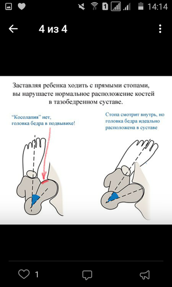"Косолапие" и распиареная орто обувь
