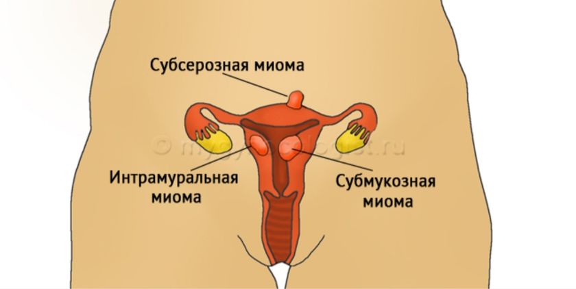Субмукозная миома