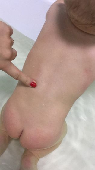 выпирает позвоночник