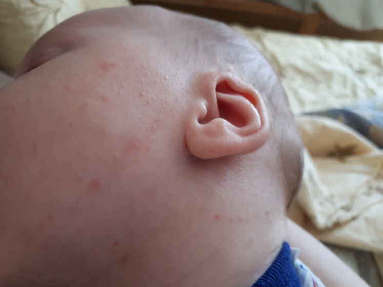 SOS аллергия или потничка?!
