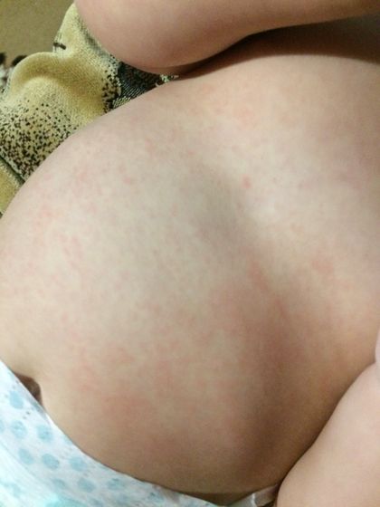 Антибиотик сумамед и аллергия и можно его отменить после 3-х дней