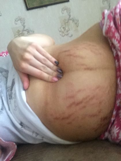 Девочки жуткие растяжки после