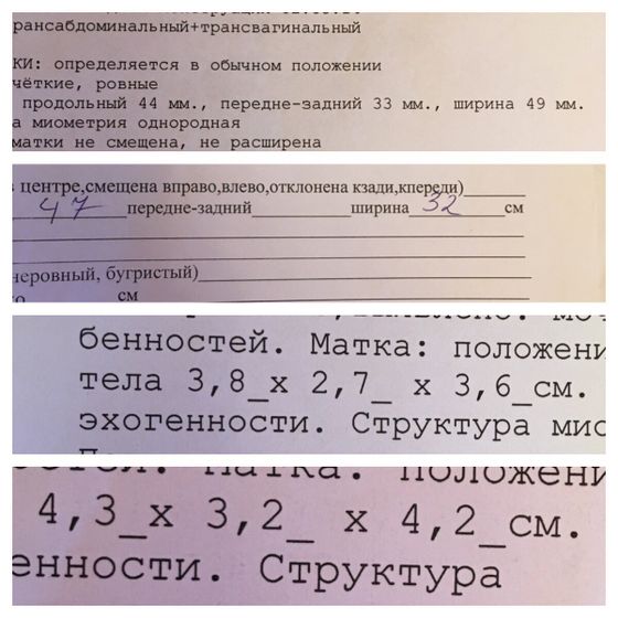 Гипоплазия матки,кому ставили такой диагноз и кто в этом разбирается,помогите