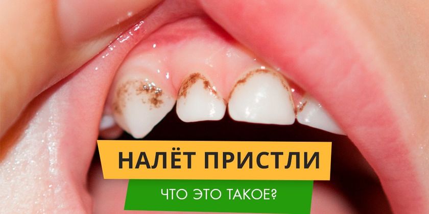 ТЕМНЫЙ НАЛЕТ НА ЗУБАХ - НАЛЕТ ПРИСТЛИ