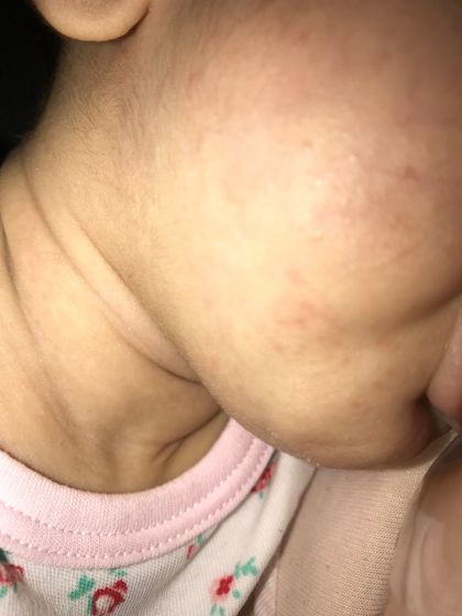 Сыпь по телу прошла