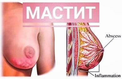 Мастит