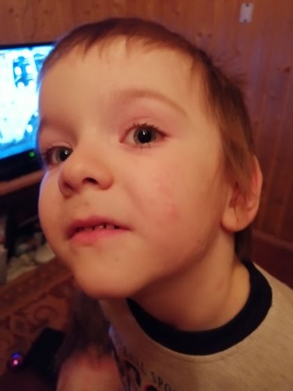 Кто там хотел посмотреть на постельных клопов?))