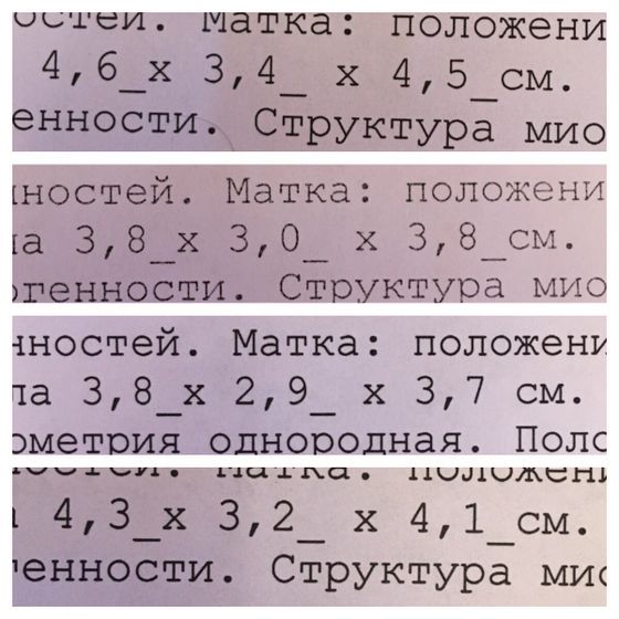 Гипоплазия матки,кому ставили такой диагноз и кто в этом разбирается,помогите