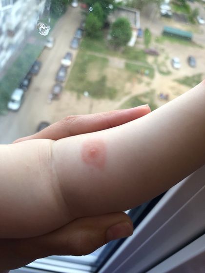 Высыпания help!
