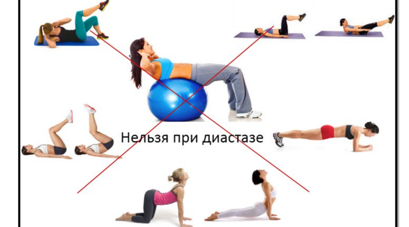 Диастаз прямых мышц живота после родов. Кто виноват и что делать?