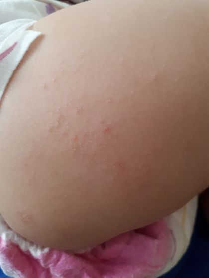 Аллергия?