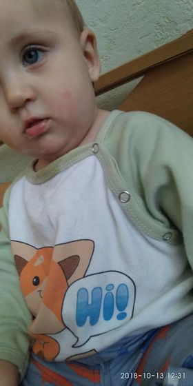 Укусы комаров