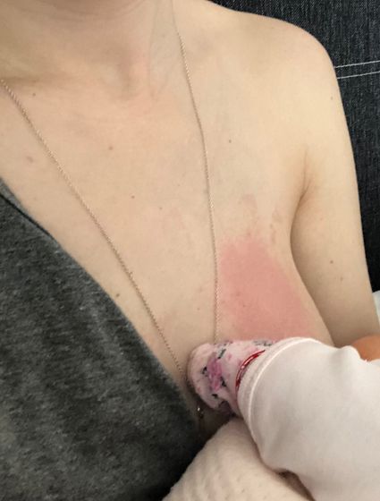 Как я избавилась от лактостаза