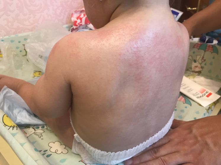 Аллергия на солнце ?