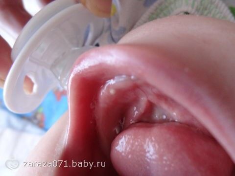 Прыщик на десне или это зуб?