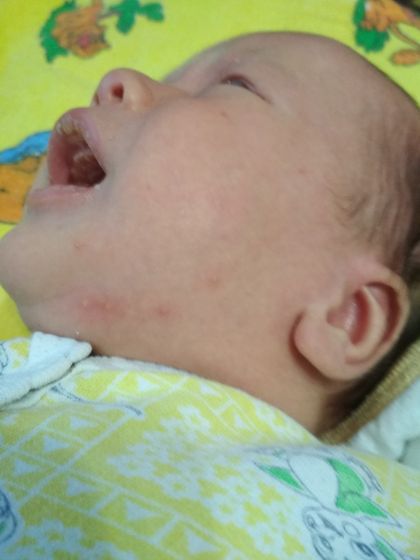 Аллергия или цветение