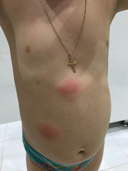 Укусы