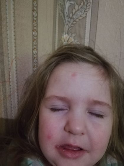 Что это за прыщи???