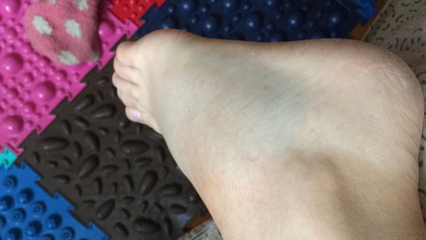 SOS!!!!! Ушиб