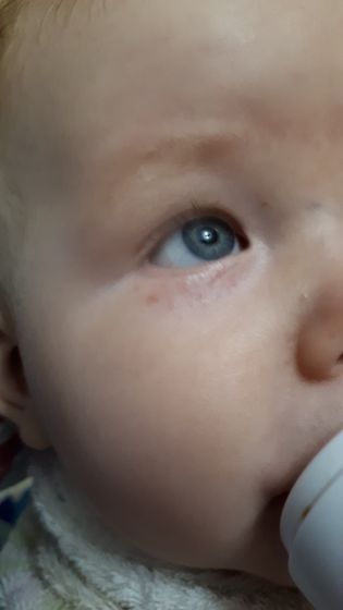 Сыпь под глазом