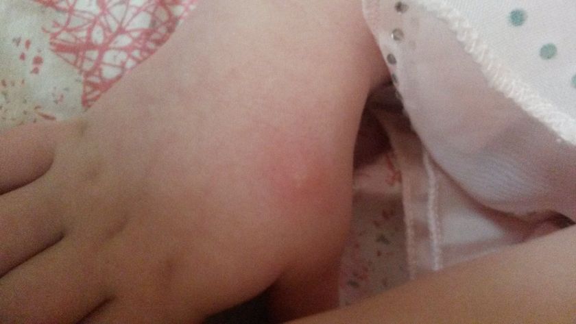 укусы
