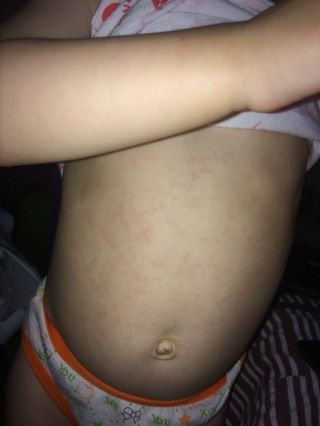 Что за сыпь?♀️?