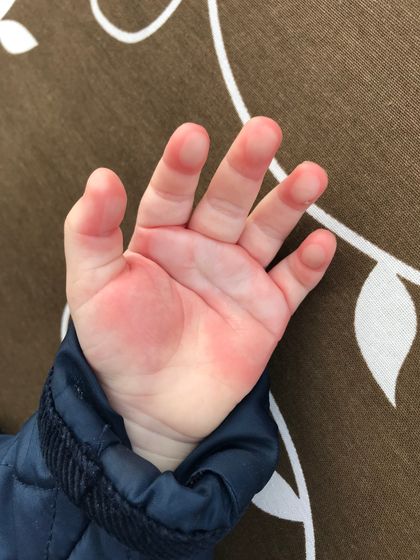 Обожгли ручку 😢