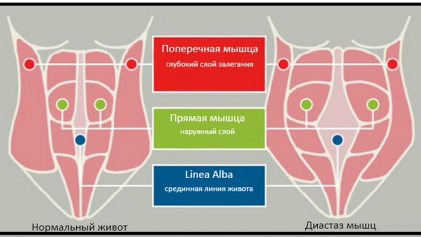 Диастаз прямых мышц живота после родов. Кто виноват и что делать?