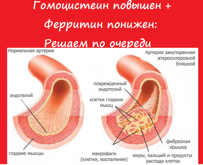 Гомоцистеин повышен+ ферритин понижен: решаем по очереди