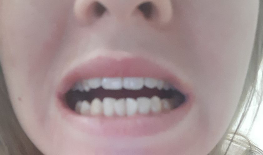 Брекеты/ имплант?
